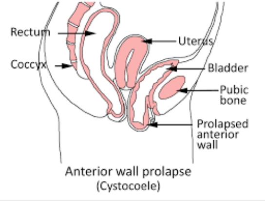 Bladder Prolapse
