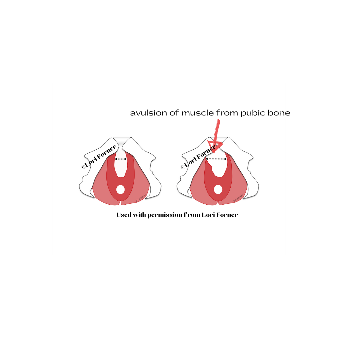 diagram of hiatal width and elevator avulsion